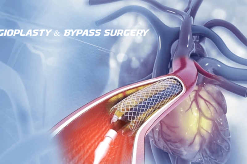 Where Can You Find the Best Hospital for Angioplasty & Bypass Surgery?
