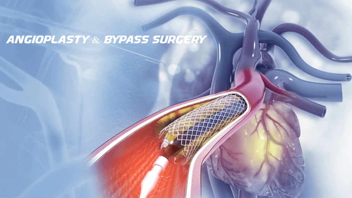 Medical illustration showing a stent placement inside a blocked artery during angioplasty, with the human heart and blood vessels in the background, representing angioplasty and bypass surgery.