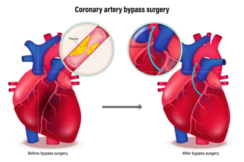 Where Can You Find the Best Hospital for Angioplasty & Bypass Surgery?