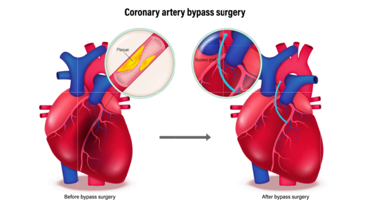Angioplasty & Bypass Surgery